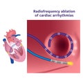 Radiofrequency catheter ablation of the heart.